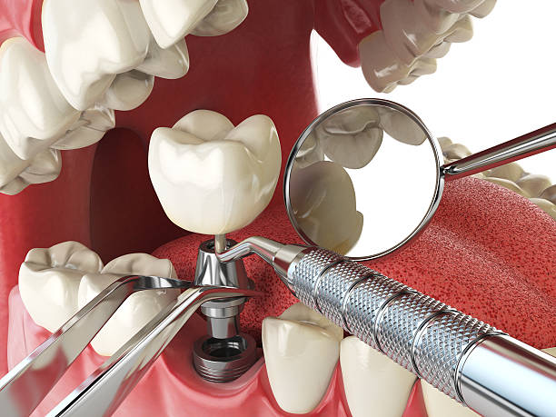 Best Emergency Root Canal Treatment in Thousand Palms, CA